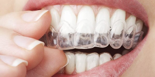 Invisalign Braces Help To Boost Your Confidence
