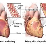 coronary artery bypass singapore