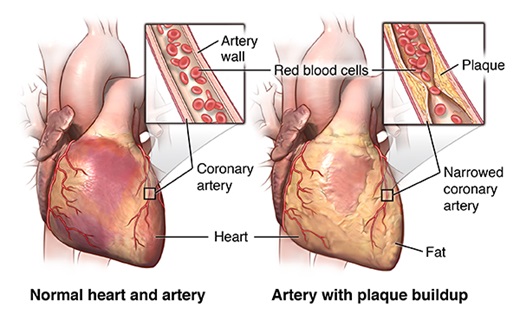 Coronary artery disease – an overview