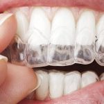 invisalign braces rego park ny