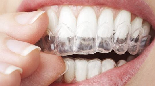 Invisalign Braces Help To Boost Your Confidence